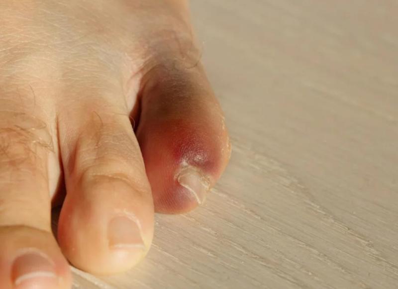 脚趾碰了一下怎么判断有没有骨折,脚趾扭伤怎么判断有没有伤到骨头