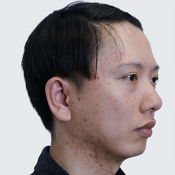 痘印痘坑做微针有效果吗,小伙子痘坑修复亲身经历