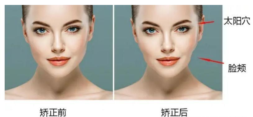 中年人正畸后的后遗症,正畸都会有什么后遗症