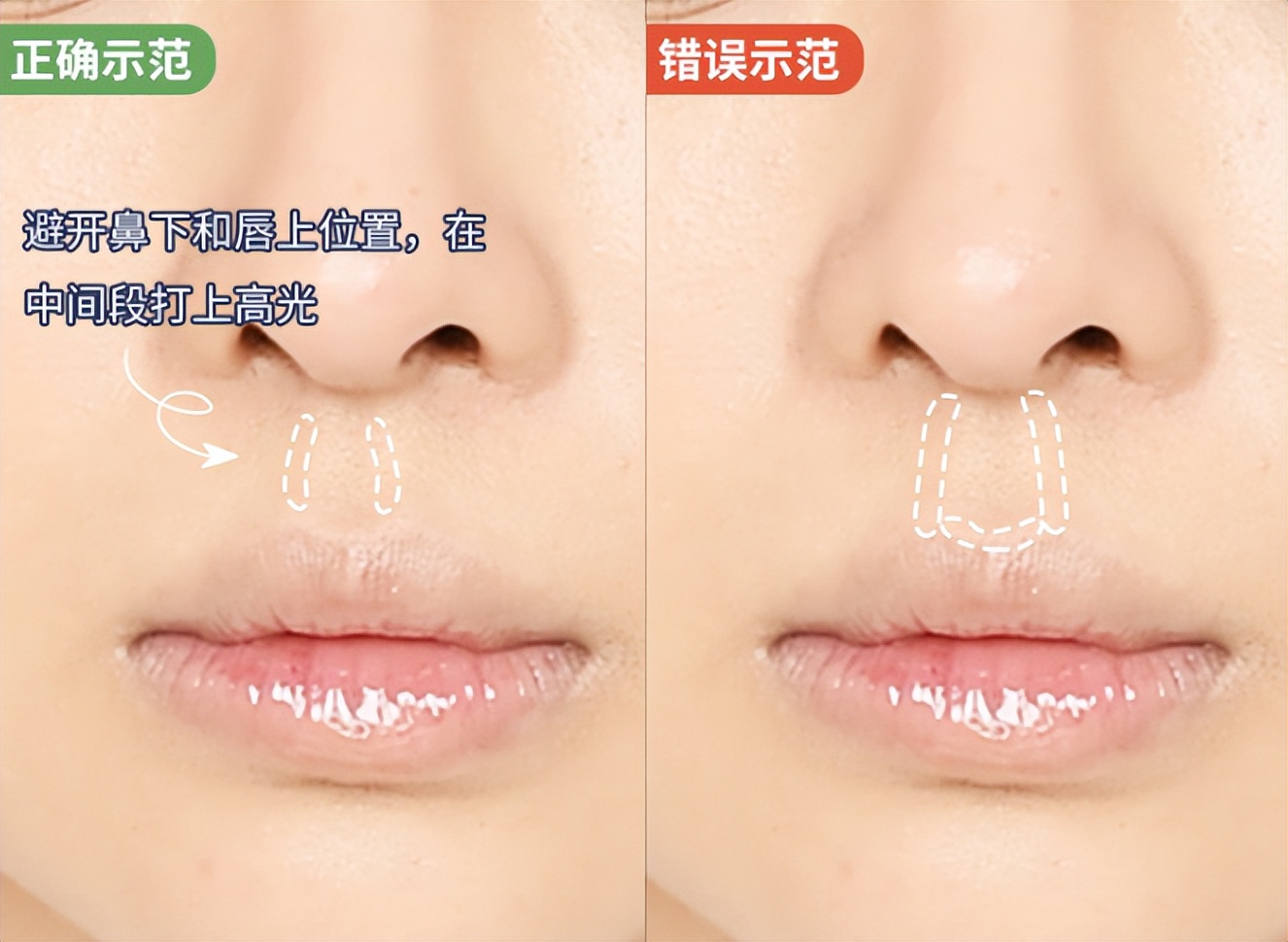 人中缩短修复,人中长显老怎么改善