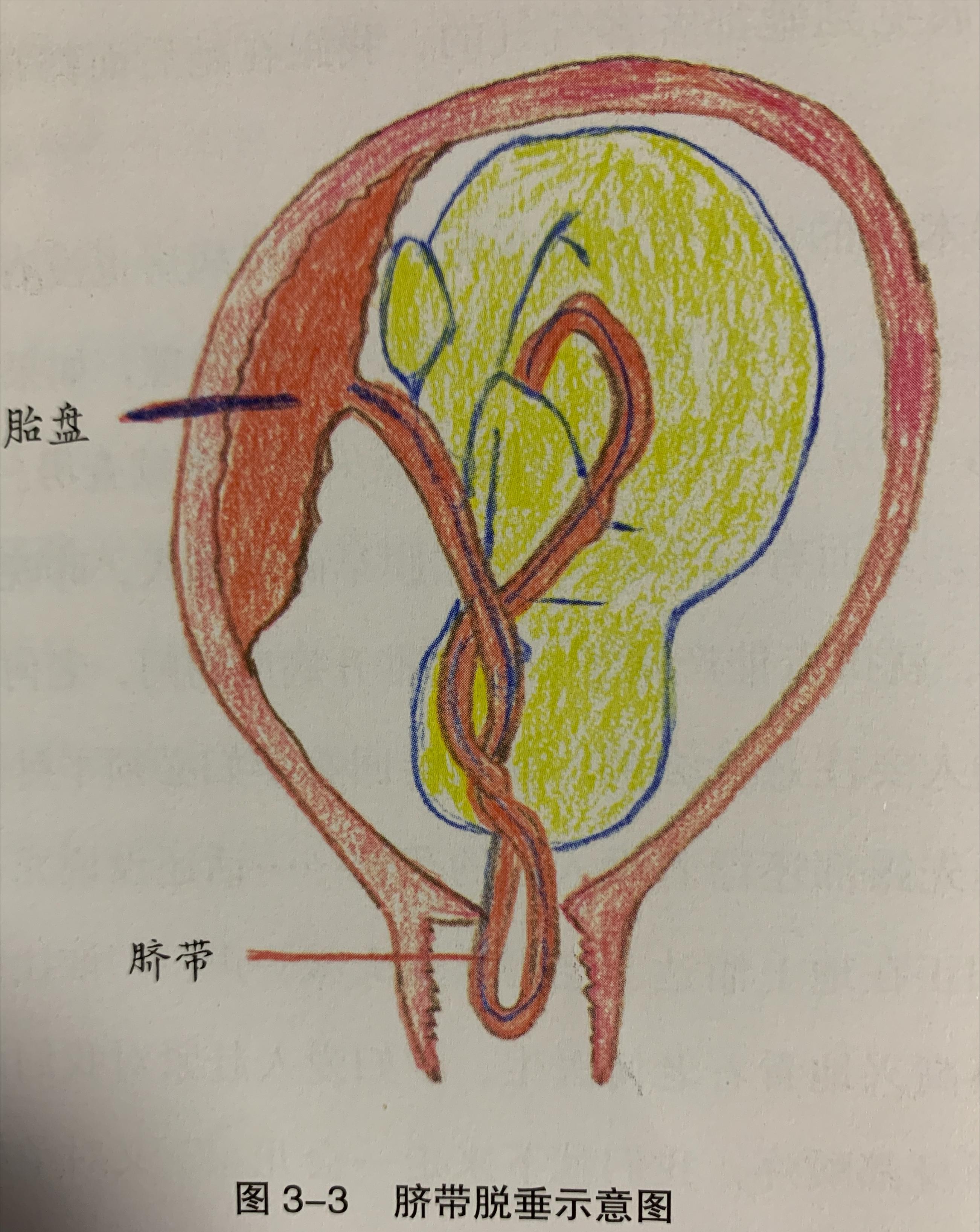 孕妇脐带脱垂有哪些前兆,胎儿脐带绕颈30圈造成胎儿窒息