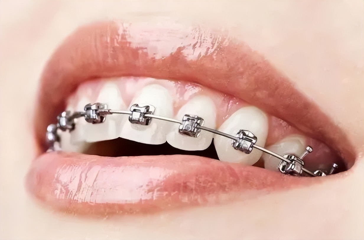 矫正牙齿想戴透明牙套,成人隐形牙套矫正牙齿大概多少钱