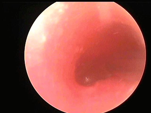 耳朵里面发霉长毛要清除吗,耳朵里长毛发霉了