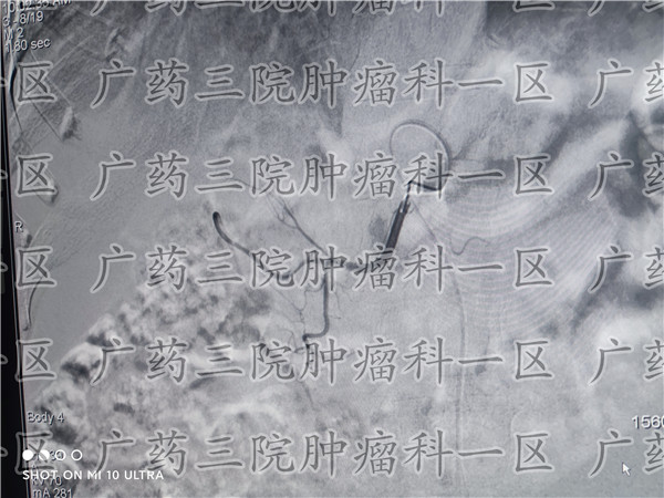 宫颈癌综合治疗,宫颈癌需要治疗么