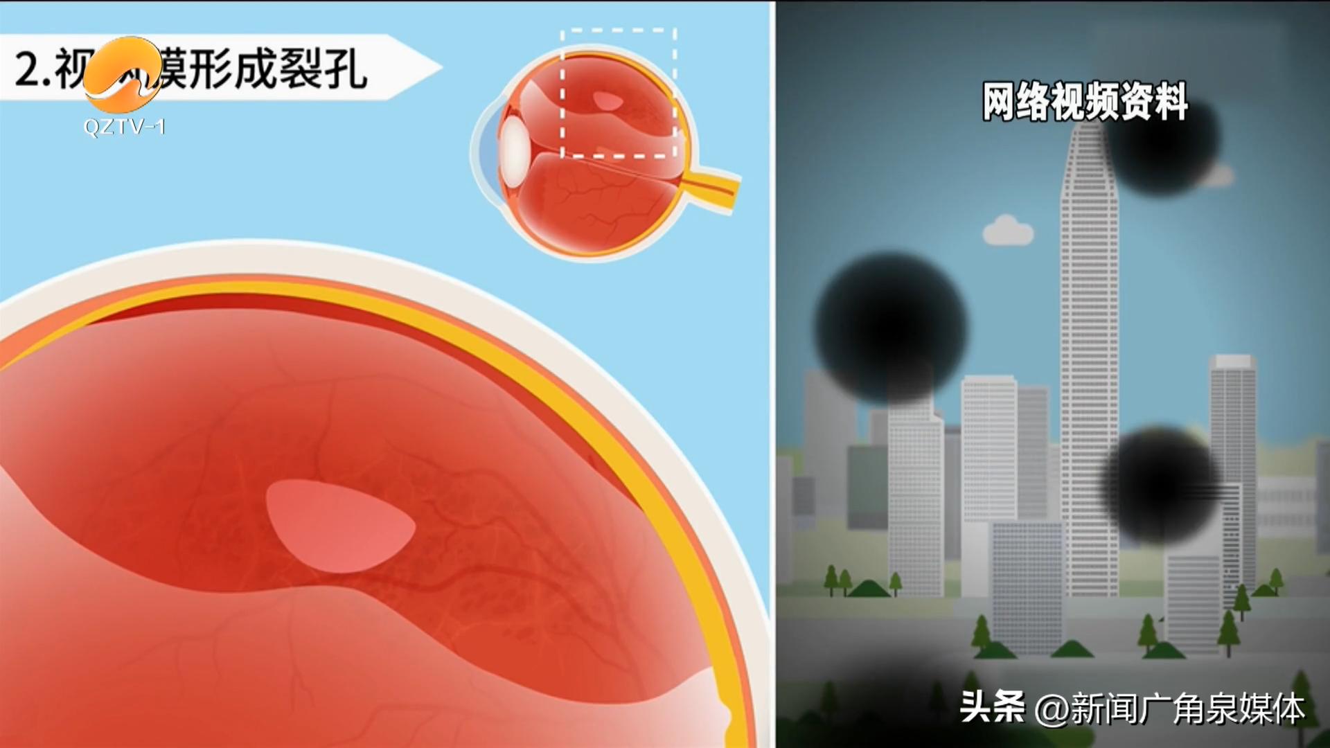 健康提示：眼前出现“飞蚊乱舞”竟是视网膜脱落