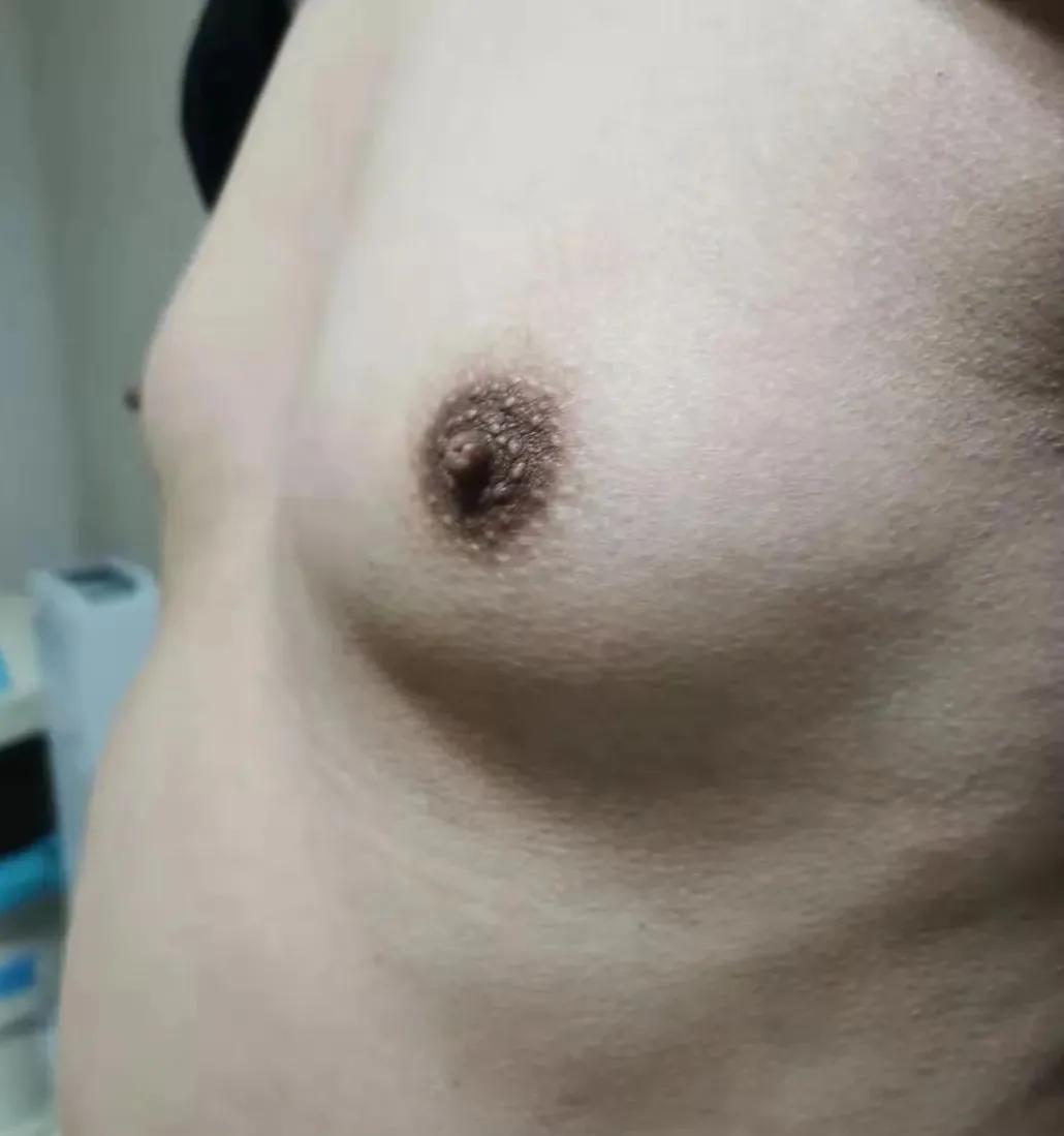 乳腺增生跟有没有男朋友有关系吗,男生乳腺增生可以通过锻炼治愈吗