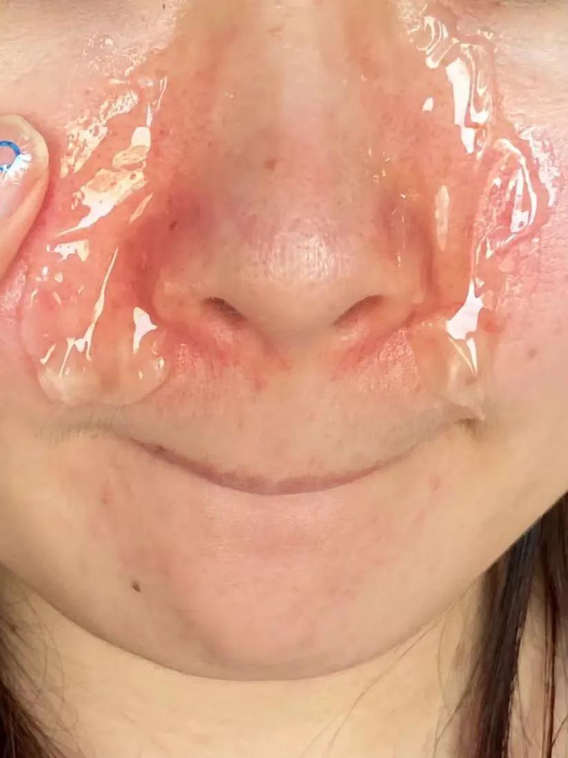 鼻子干燥起皮化妆怎么急救,妆后起皮卡粉怎么急救