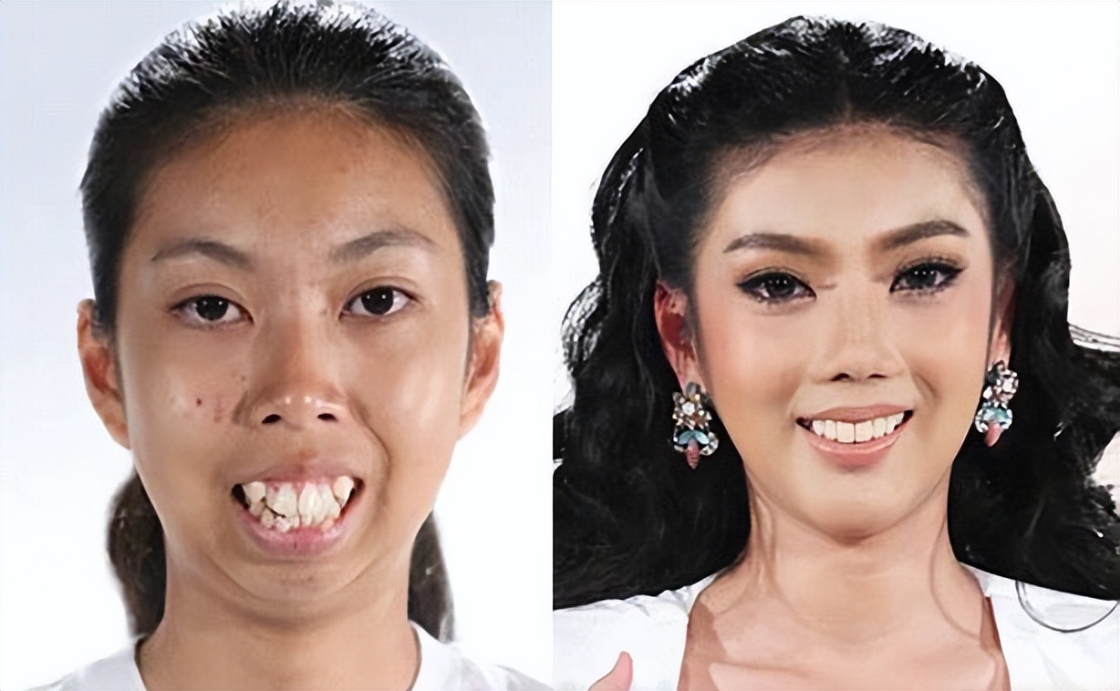 泰国女孩没有下巴,泰国整容最成功的女星