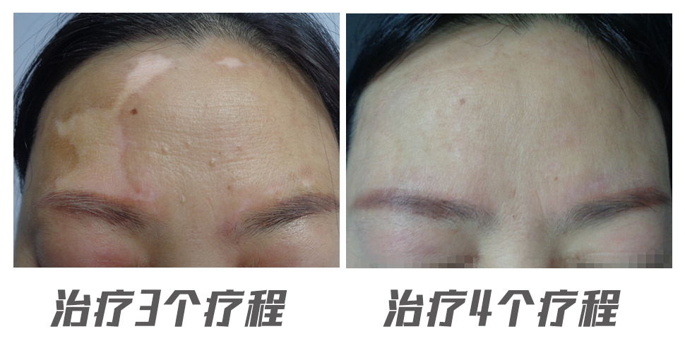 脸上的白癜风发展的太快好冶吗,面部白癜风恢复经历