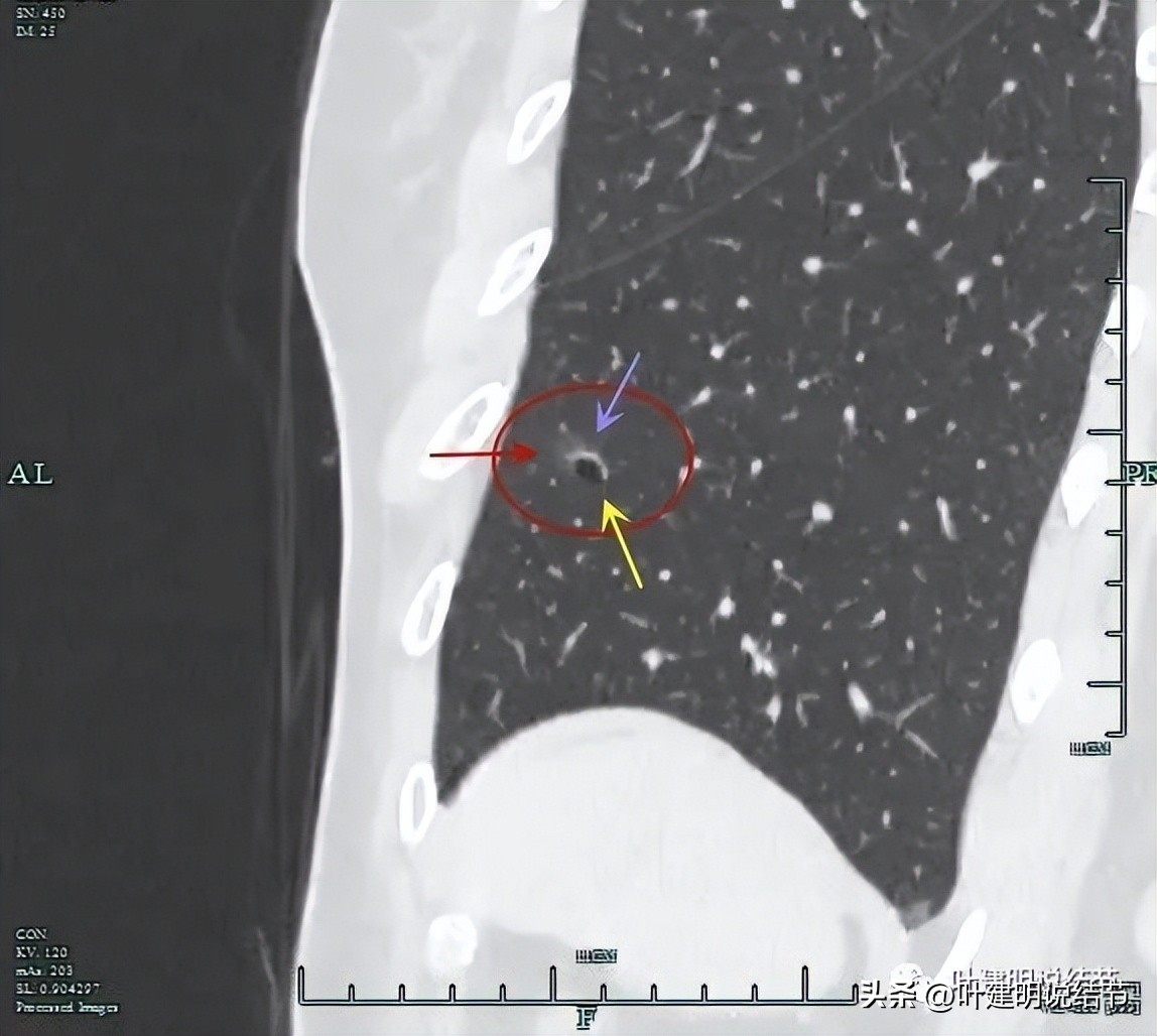 辽宁省肺结节手术哪家医院好,辽宁肺结节手术医院