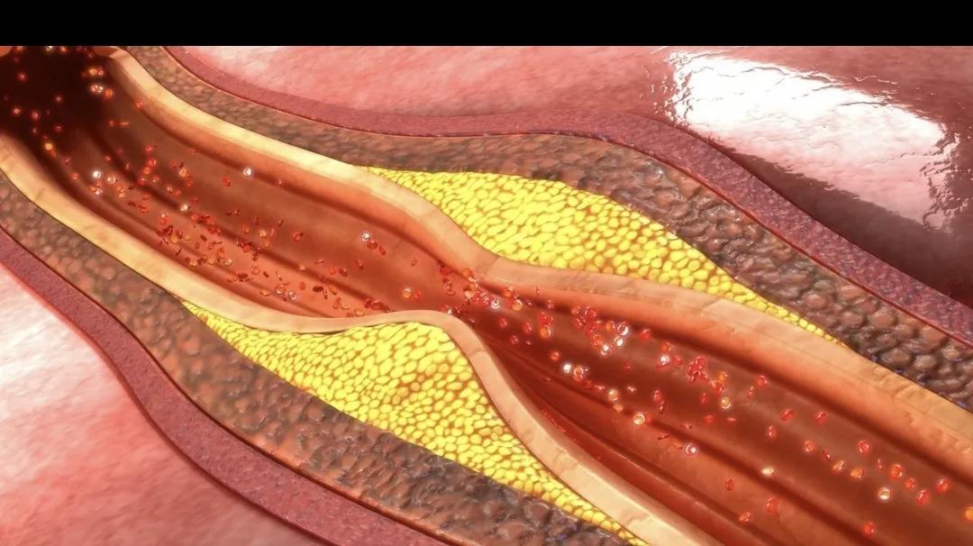 冠心病支架手术后肺会不好吗,冠心病做完支架后支架会移动吗