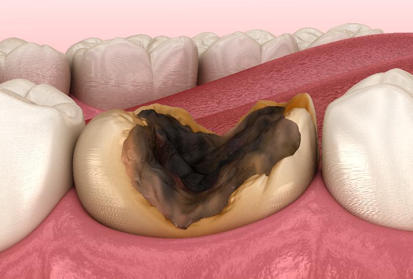 孩子蛀牙都说不疼，难道就真的不用补，不用拔了吗？
