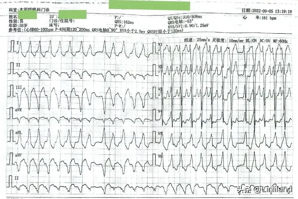 过速性房颤治疗,持续性房颤心动过速
