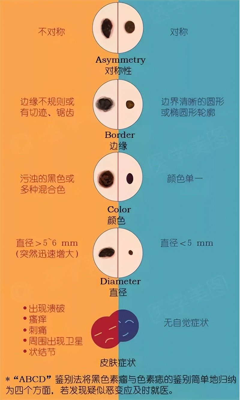 脸上的痣可以点掉吗,脸上有痣激光去痣好还是药水点好