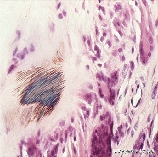急性痛风吃秋水仙碱配什么,痛风吃秋水仙碱和非布司他的方法