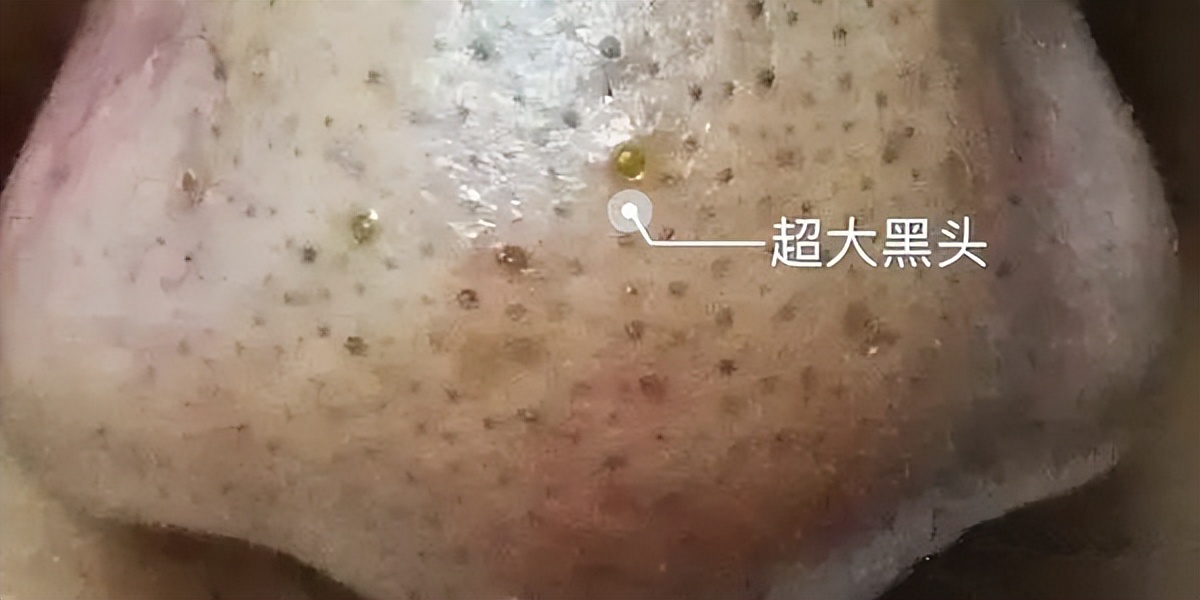 美容院护肤去黑头正常价格,小气泡去黑头美容仪器