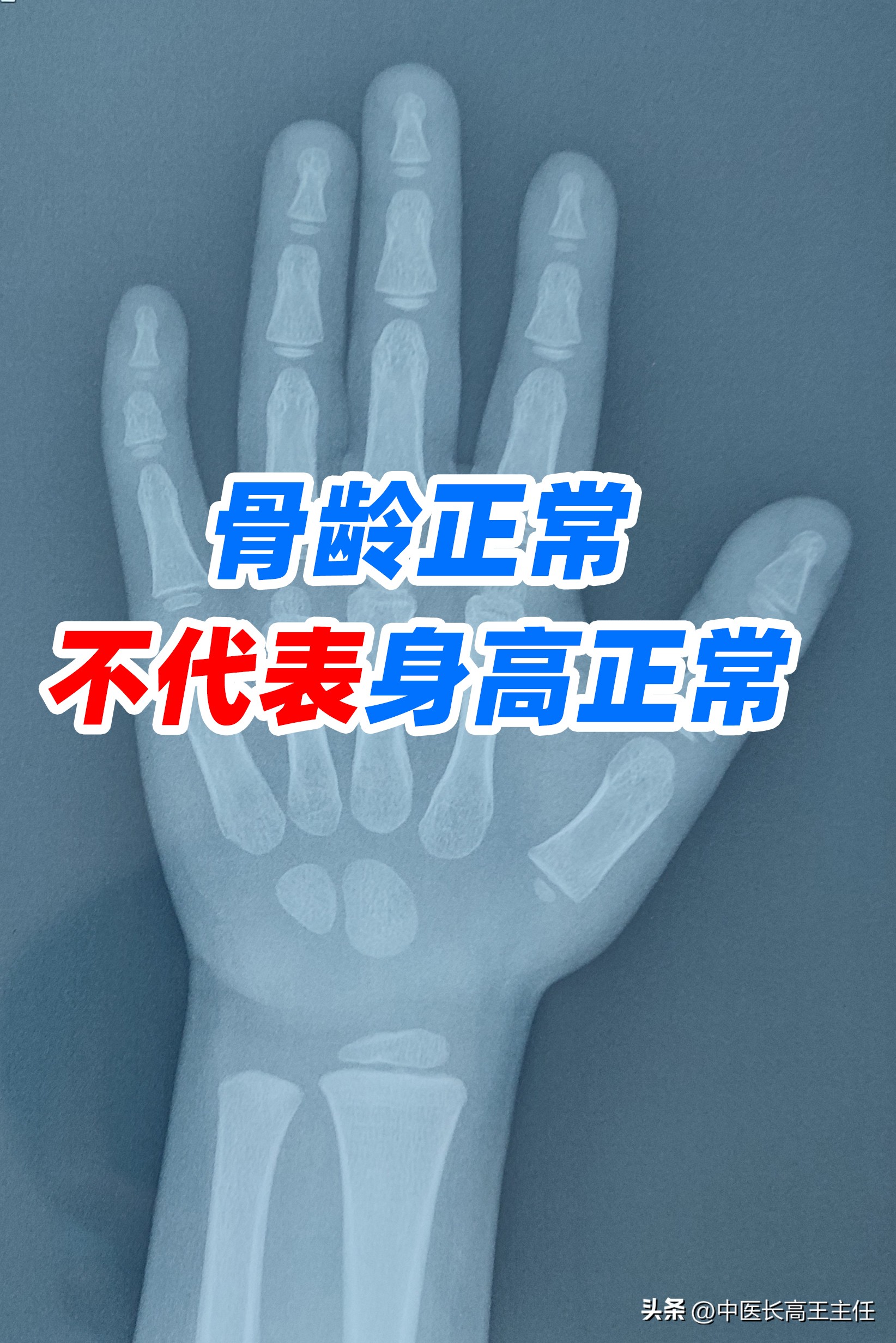 骨龄对身高有绝对影响吗,儿童骨龄正常身高不达标需要干预