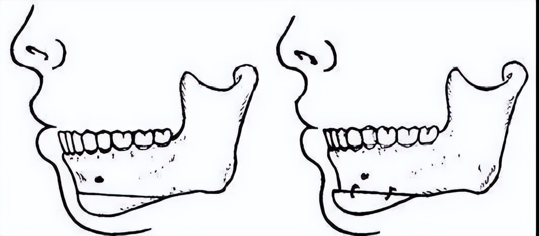下巴后缩要怎么整形,下巴后缩做什么手术矫正