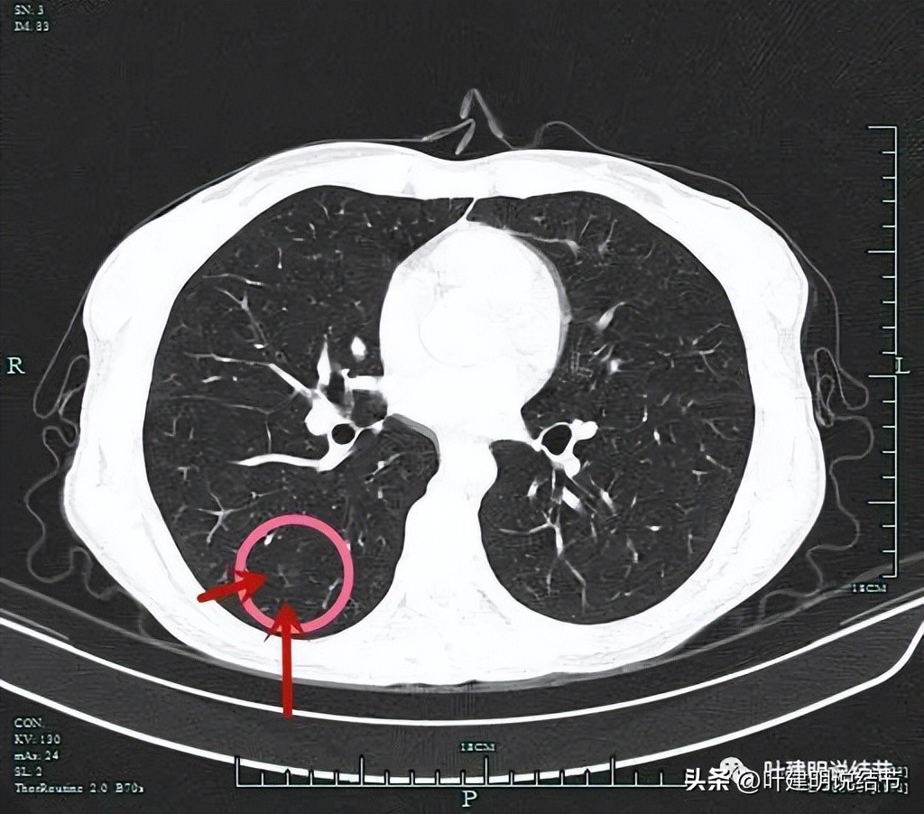 右下叶磨玻璃结节5*4,右下叶磨玻璃样结节多为炎性