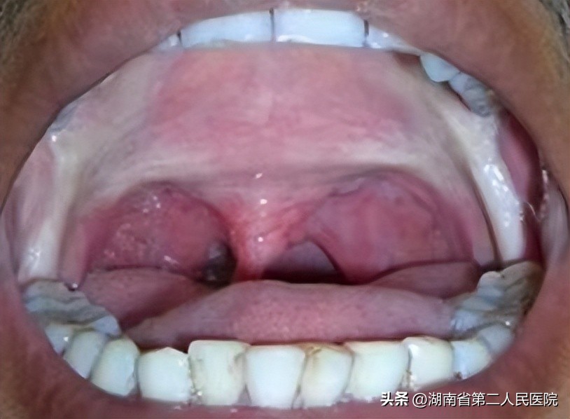 嘴巴越来越张不开什么原因,嘴巴张不开了怎么治好