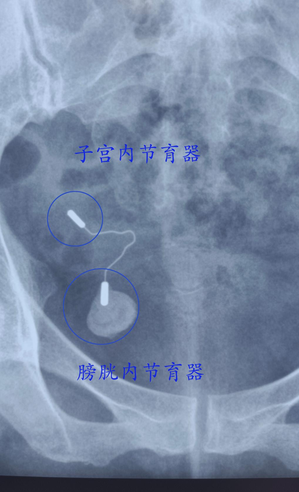 哈医大一院群力妇科,哈医大一院群力分院妇产科