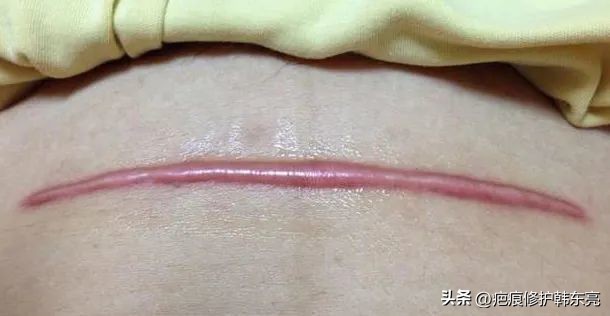 疤痕修复一次需要多少钱,上海九医院疤痕修复价目表2021