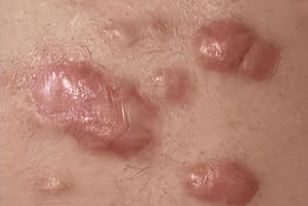 痘痘引起的瘢痕疙瘩怎么治疗,下巴痘痘变成硬疙瘩消除无疤痕