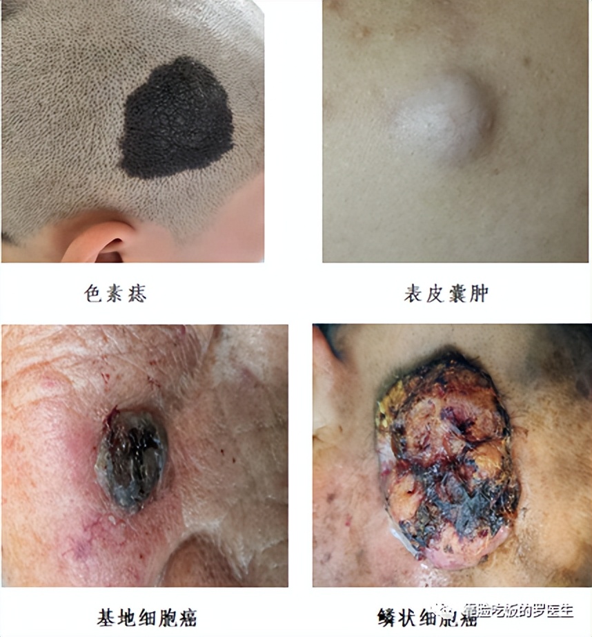 脸上的痣带毛还比较大怎么去除,脸上的痣去掉后长了个肉疙瘩