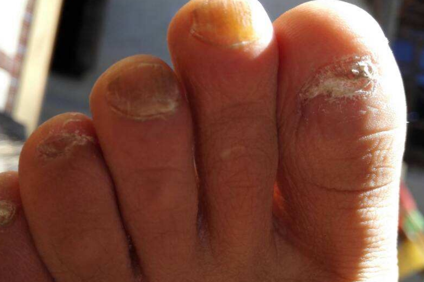 手把手教你如何治灰指甲,得了灰指甲用亮甲怎么样