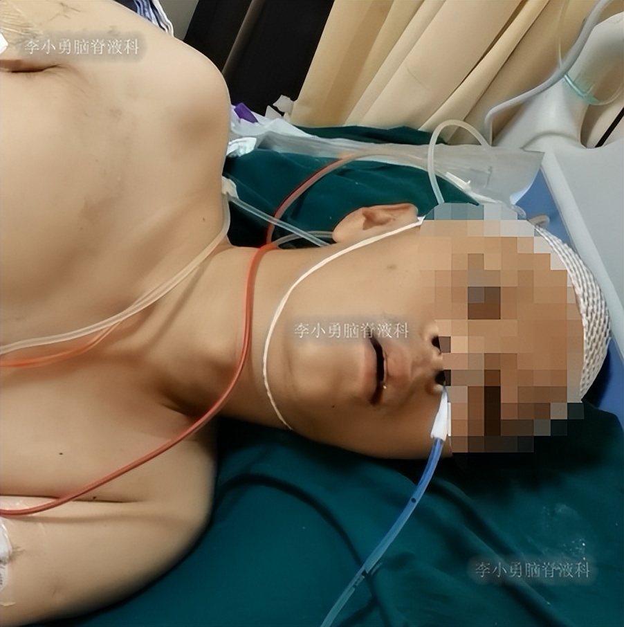 脑积水三脑室造瘘多久能恢复,脑囊虫手术后脑积水