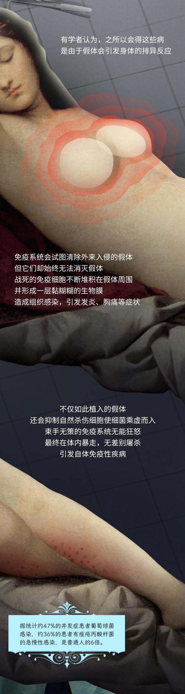 第一批假体隆胸的人现在如何,第一批脂肪隆胸的人现在怎么样