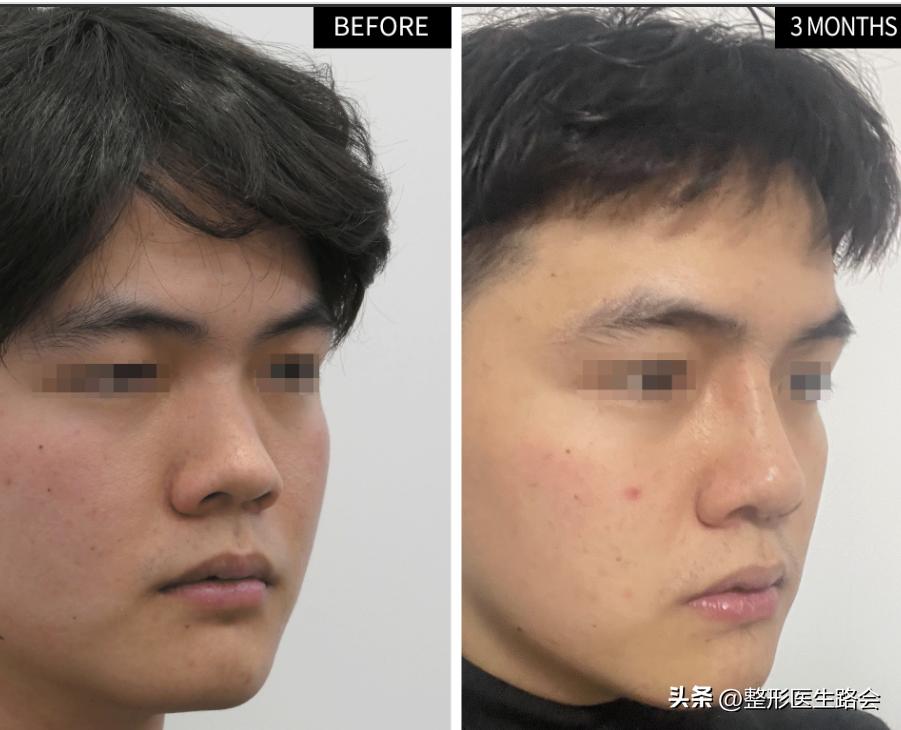 膨体隆鼻恢复期大揭秘,膨体隆鼻多年后真实感受
