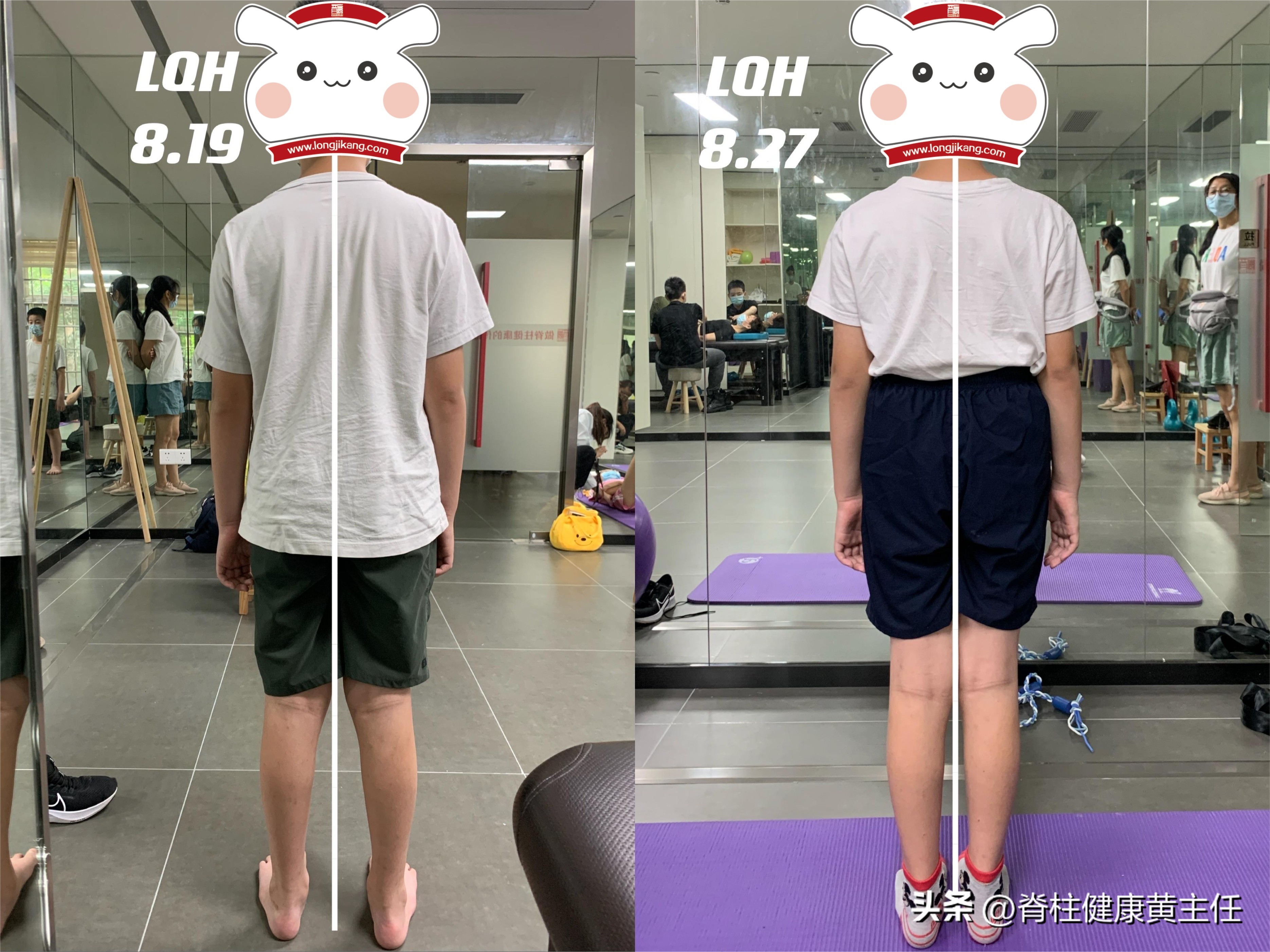 扁平足o型腿骨盆前倾高低肩,一只脚是扁平足怎么矫正