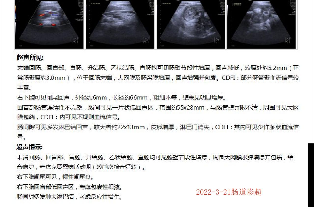 克罗恩肠粘连肠瘘能自愈吗,克罗恩出现肠瘘如何治疗