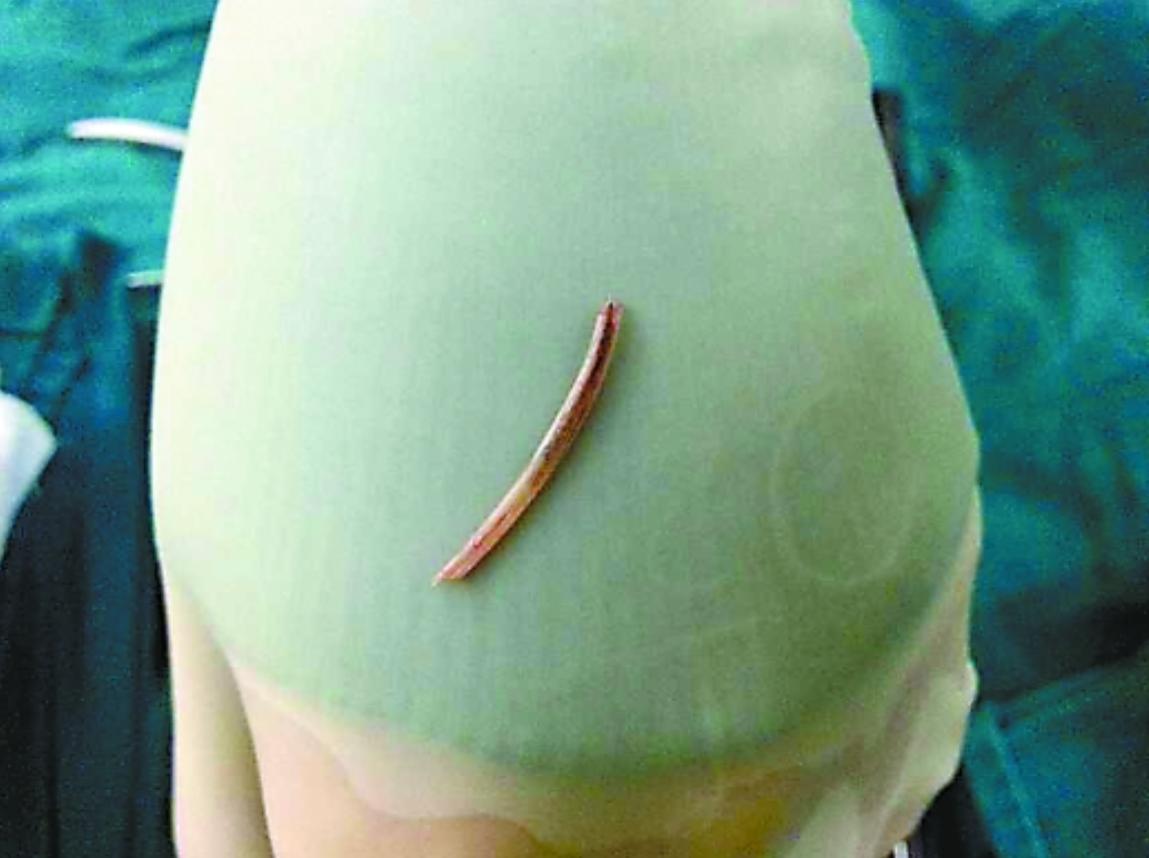 2010年,厦门小伙连续3月反复高烧,医生打开心脏夹出3厘米的鱼刺