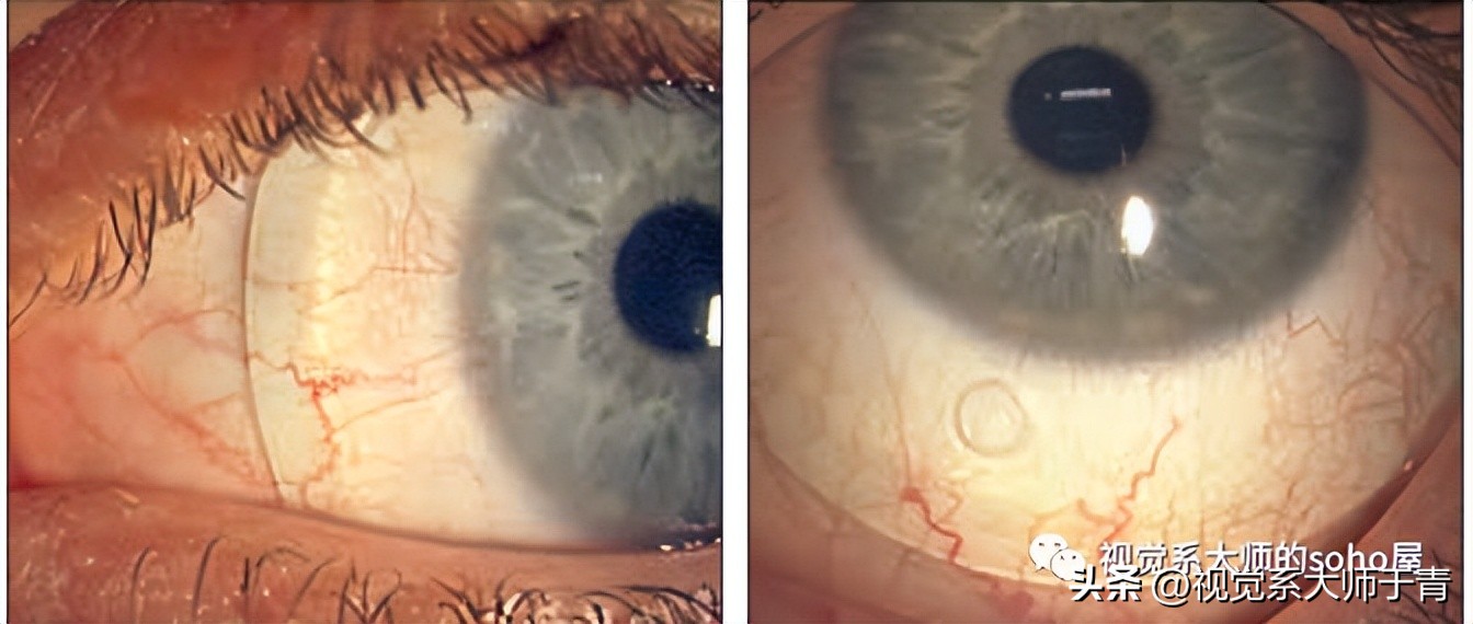 巩膜镜的验配技巧及案例分享,试戴巩膜镜成功率高不高