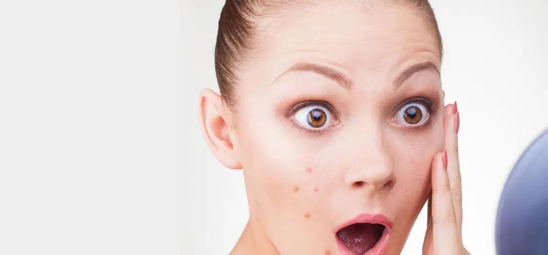 男生祛痘反复长痘怎么办,男生额头长痘什么原因引起