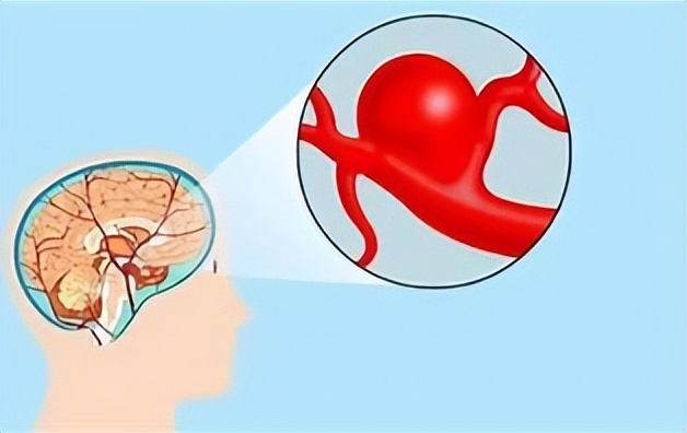 脑动脉瘤出血开颅手术,脑动脉瘤出血能治好吗