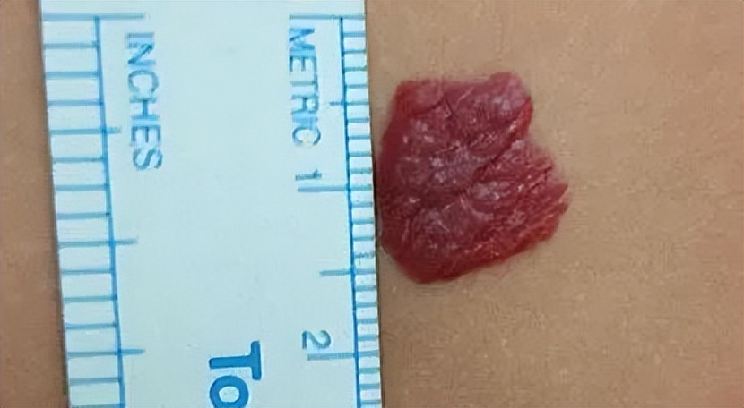 肝上面长了个血管瘤需要怎么处理,宝宝长了血管瘤怎么办