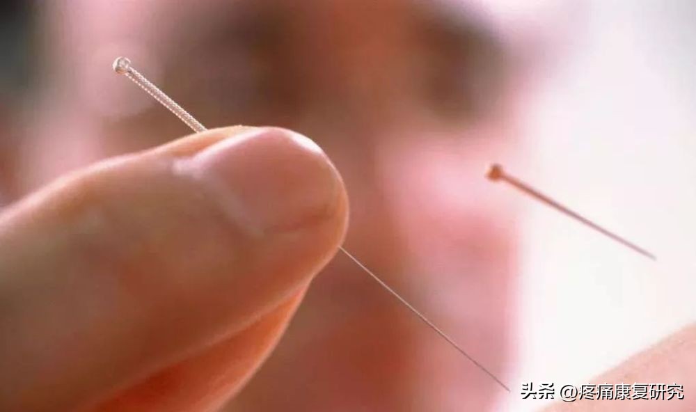 针灸止痛的原理图,针灸镇痛已被国际公认