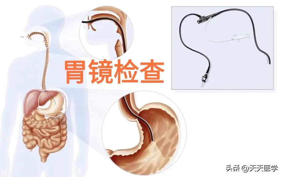 长期胃病患者多久一次胃镜检查,胃病患者多长时间做一次胃镜检查