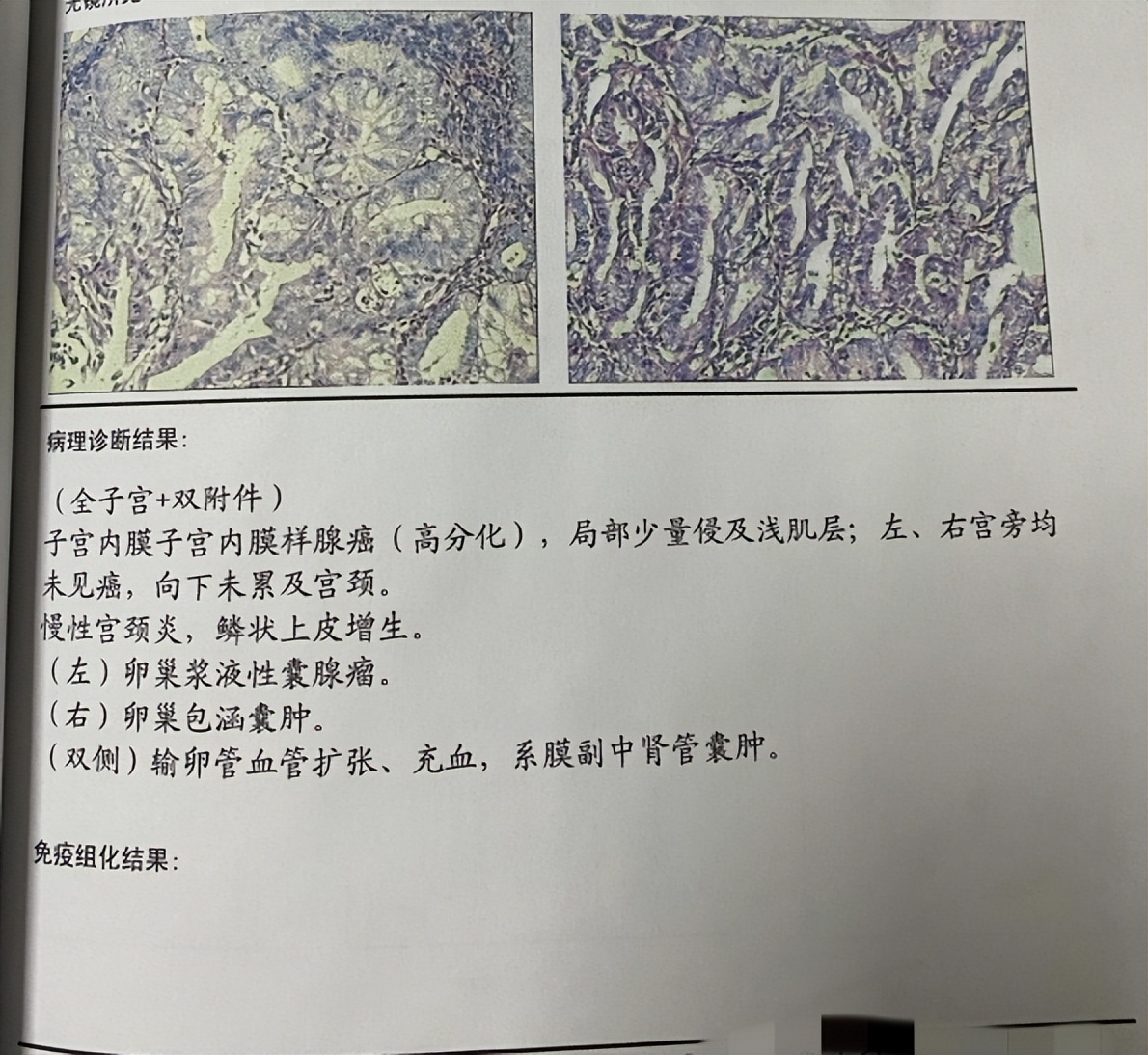 绝经后又来月经了中医怎么讲,绝经后的子宫癌症状