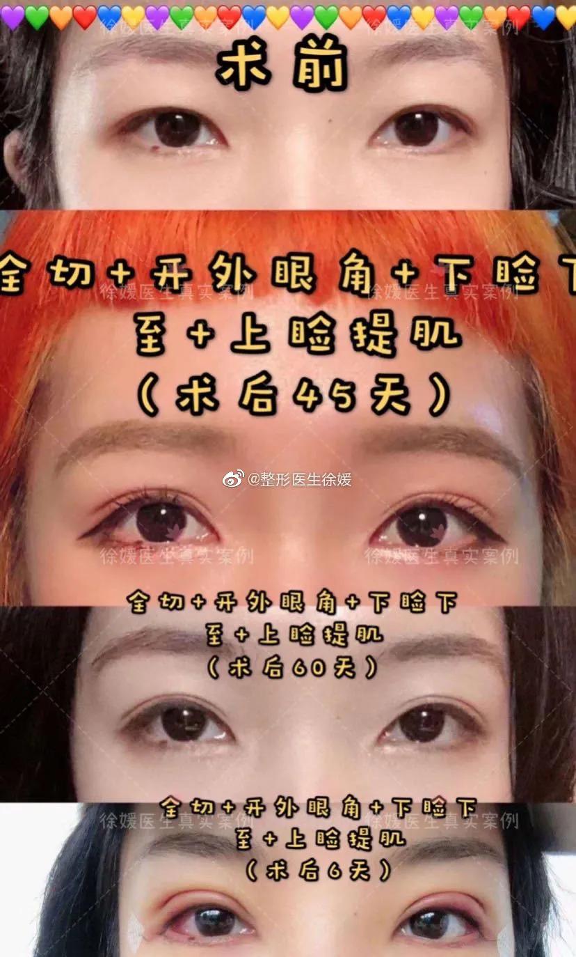 外眼角手术前后对比,做外眼角和不做外眼角的差别