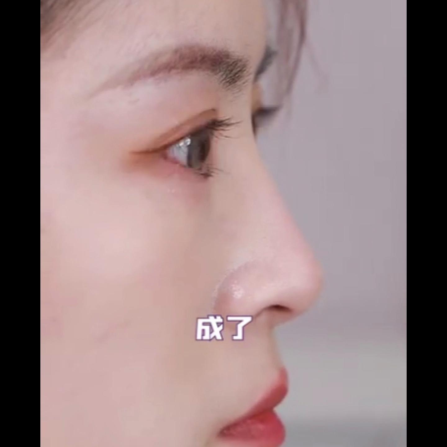 隐形牙套变美过程,隐形矫正变美