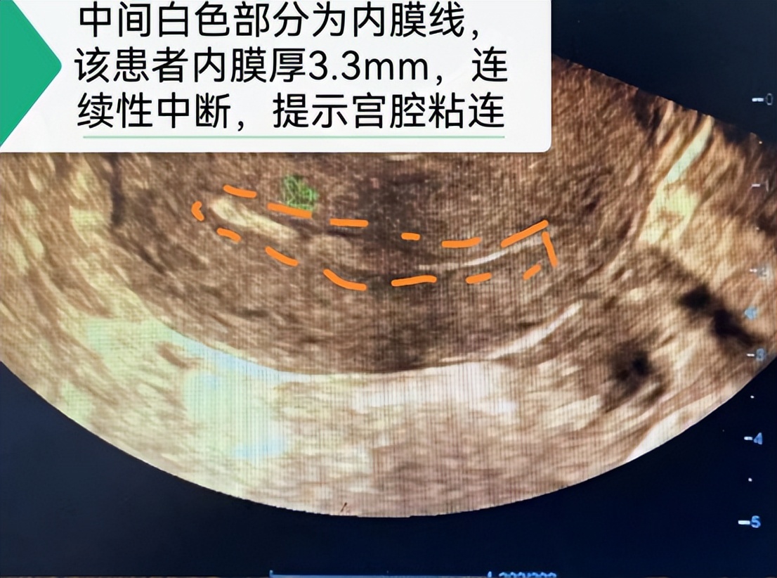 女性宫腔粘连可以做试管婴儿吗,宫腔粘连术后怀孕失败