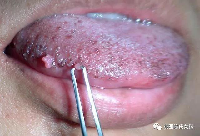 尖锐湿疣严重吗,尖锐湿疣是什么