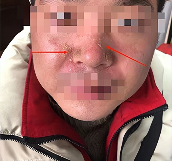 脸上反反复复红肿流黄水怎么回事,一夜之间脸上突然红肿流黄水