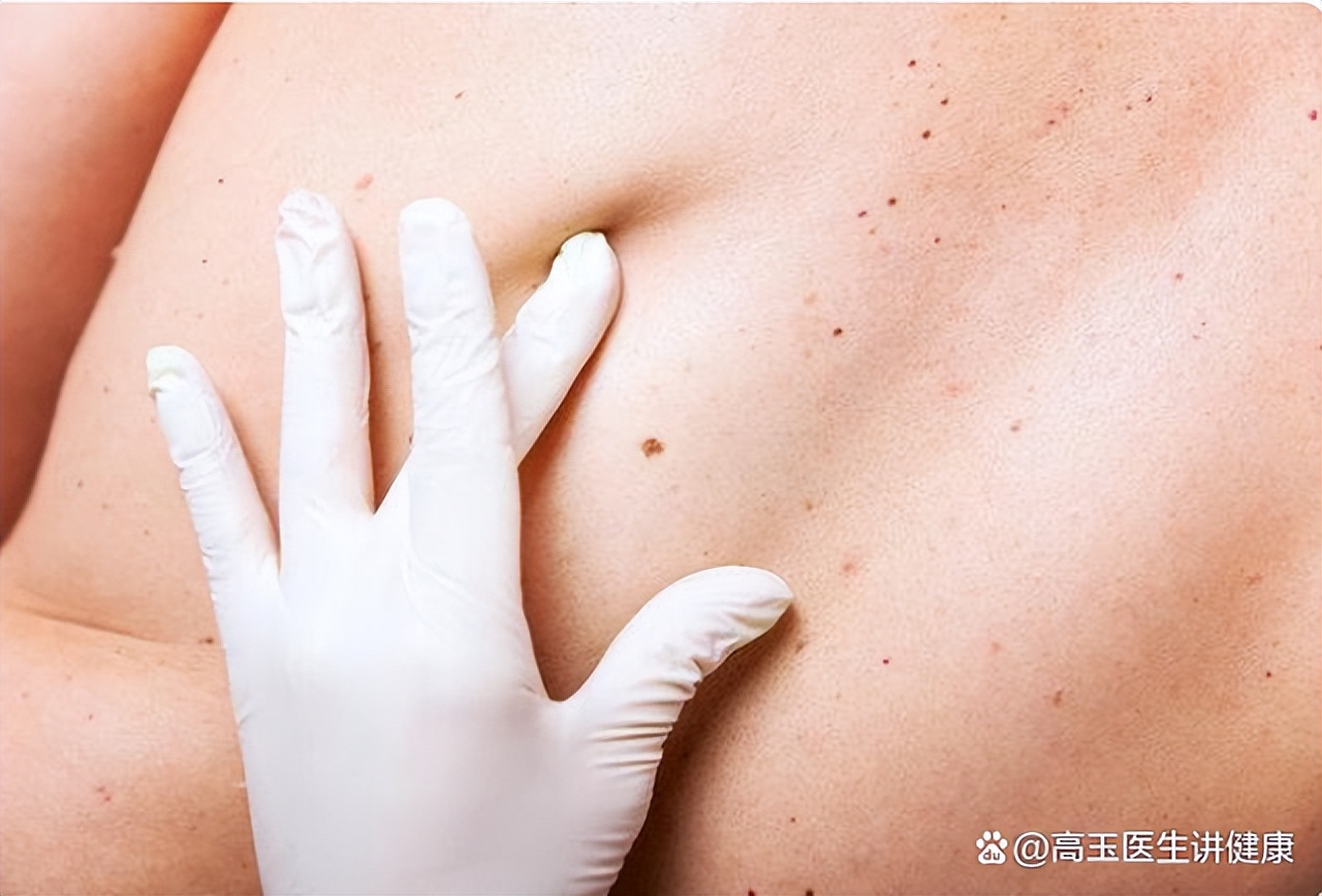 肝病皮肤出现蜘蛛痣有多严重,蜘蛛痣是肝病早期出现吗