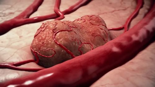 腺癌的症状和前兆,转移性腺癌属于什么癌症