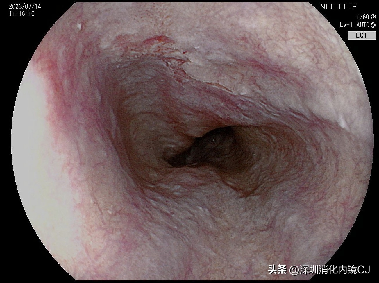 69岁及时发现食管癌，内镜下微创根治，避免了外科开胸手术